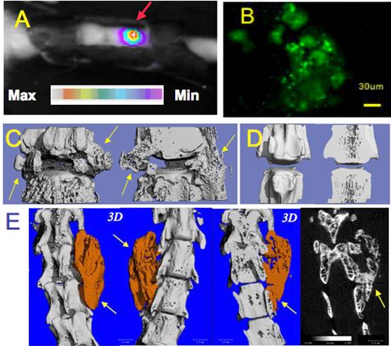 Anterior and Posterior stem cell-based spinal fusion