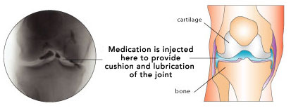 Injection